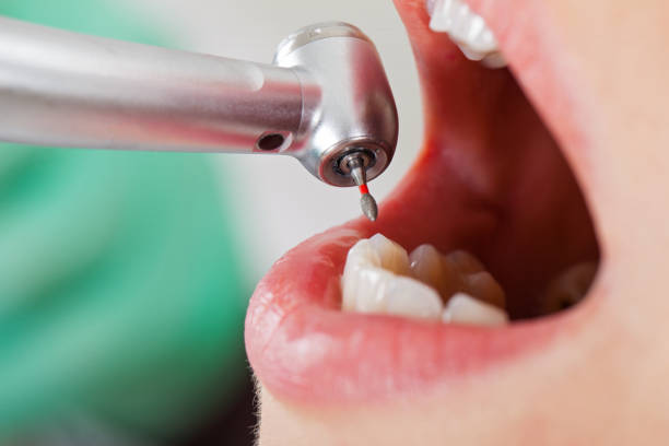 Best Emergency Wisdom Teeth Removal in North Hudson, WI